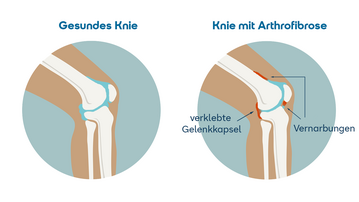 Gesundes Knie links und Knie mit Arthrofibrose rechts, mit Markierungen für verklebte Gelenkkapsel und Vernarbungen.