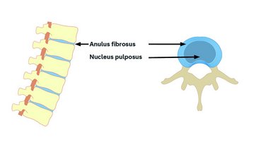 Diagramm der Wirbelsäule mit Beschriftungen für Anulus fibrosus und Nucleus pulposus, die die Struktur der Bandscheibe darstellen.